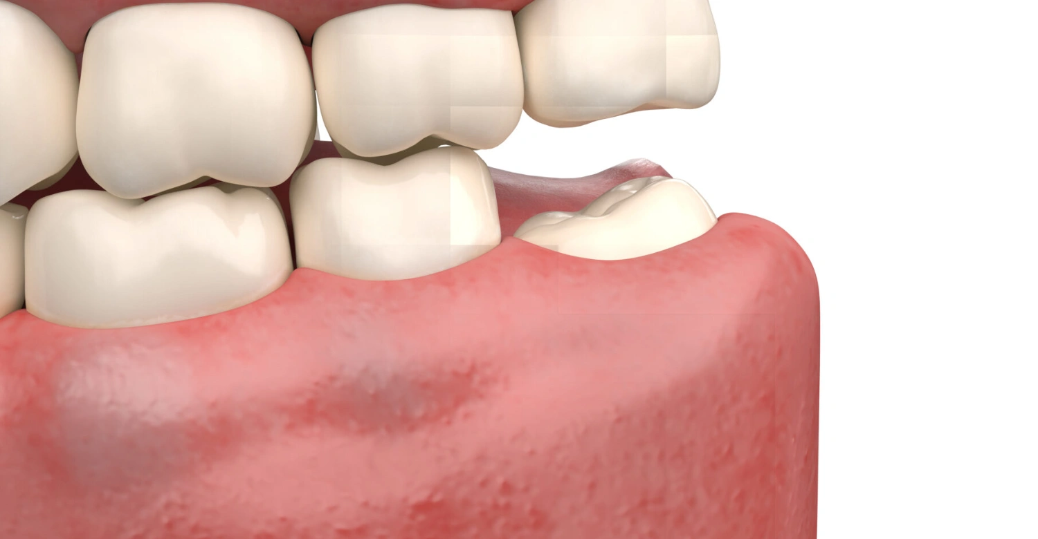 impacted tooth inblog